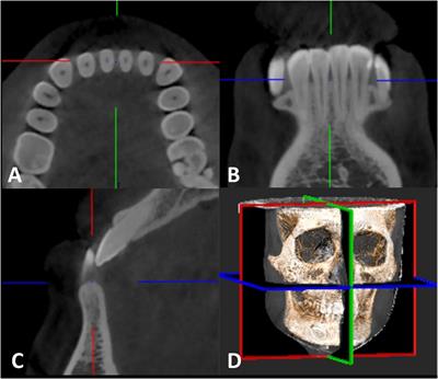 Optimal Implantation Site of Orthodontic Micro-Screws in the Mandibular Anterior Region Based on CBCT
